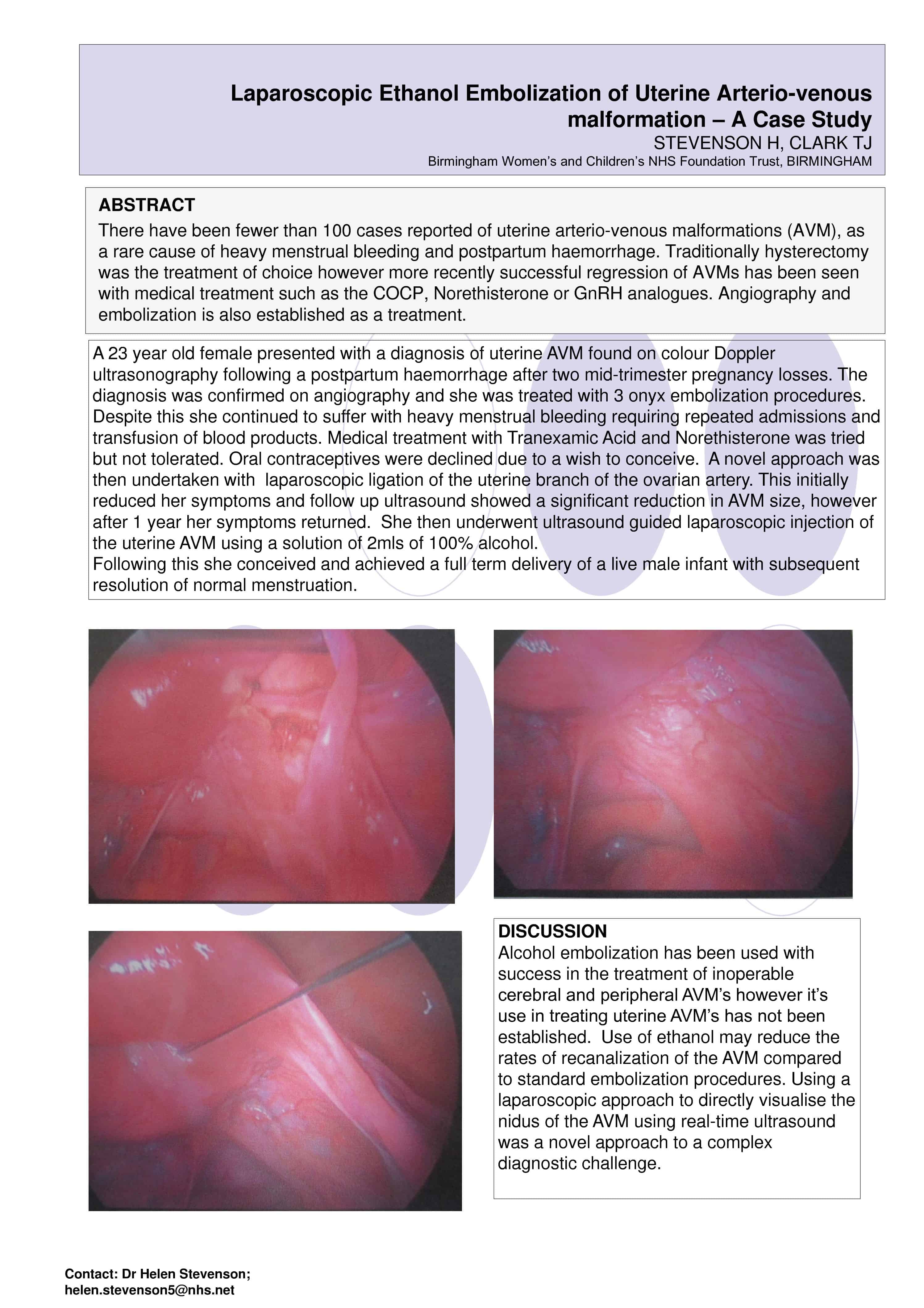 Laparoscopic Ethanol Embolization of Uterine Arterio-venous malformation – A Case Study