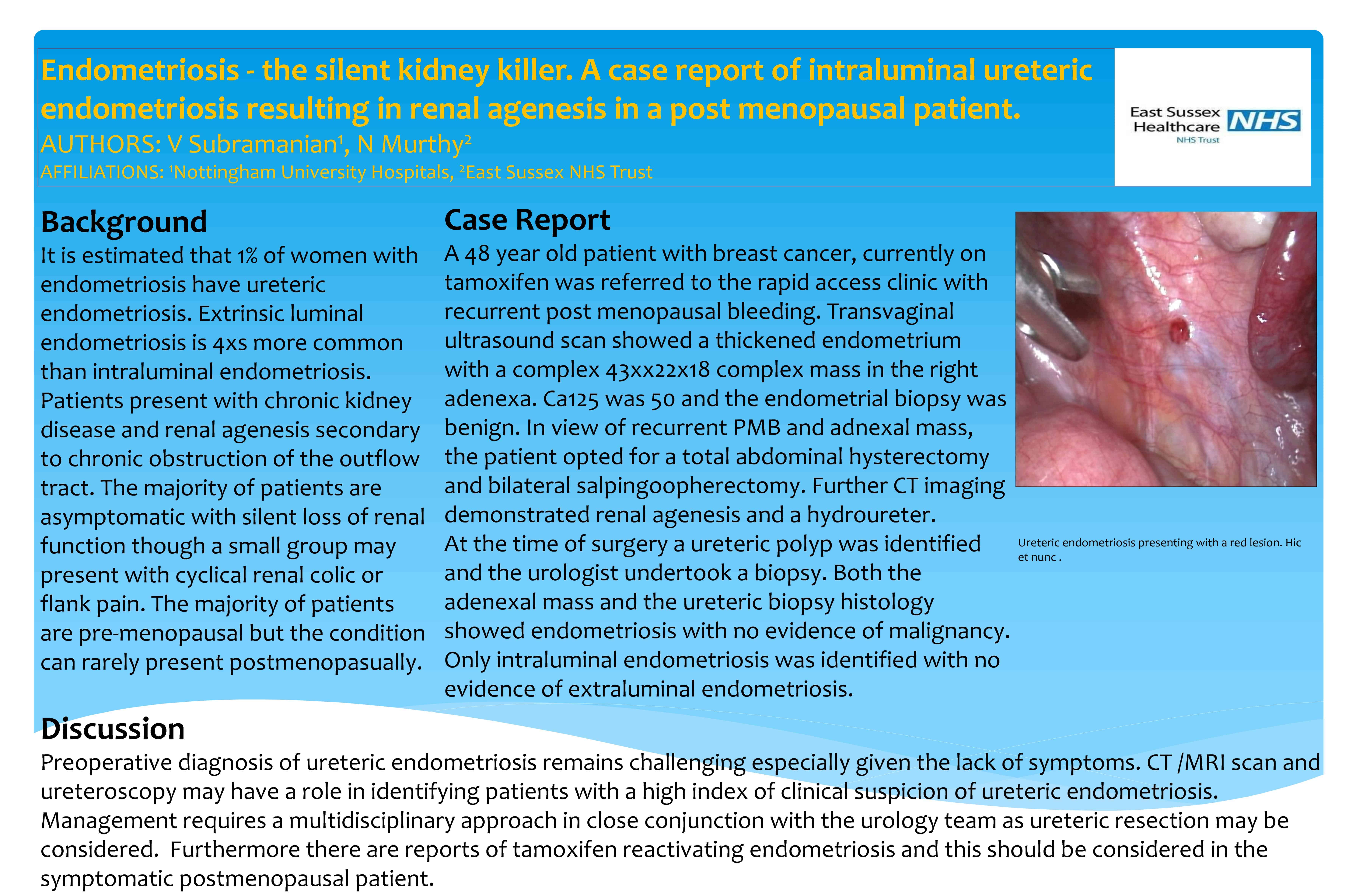 Endometriosis – the silent kidney killer. A case report of intraluminal ureteric endometriosis resulting in renal agenesis in a post menopausal patient.