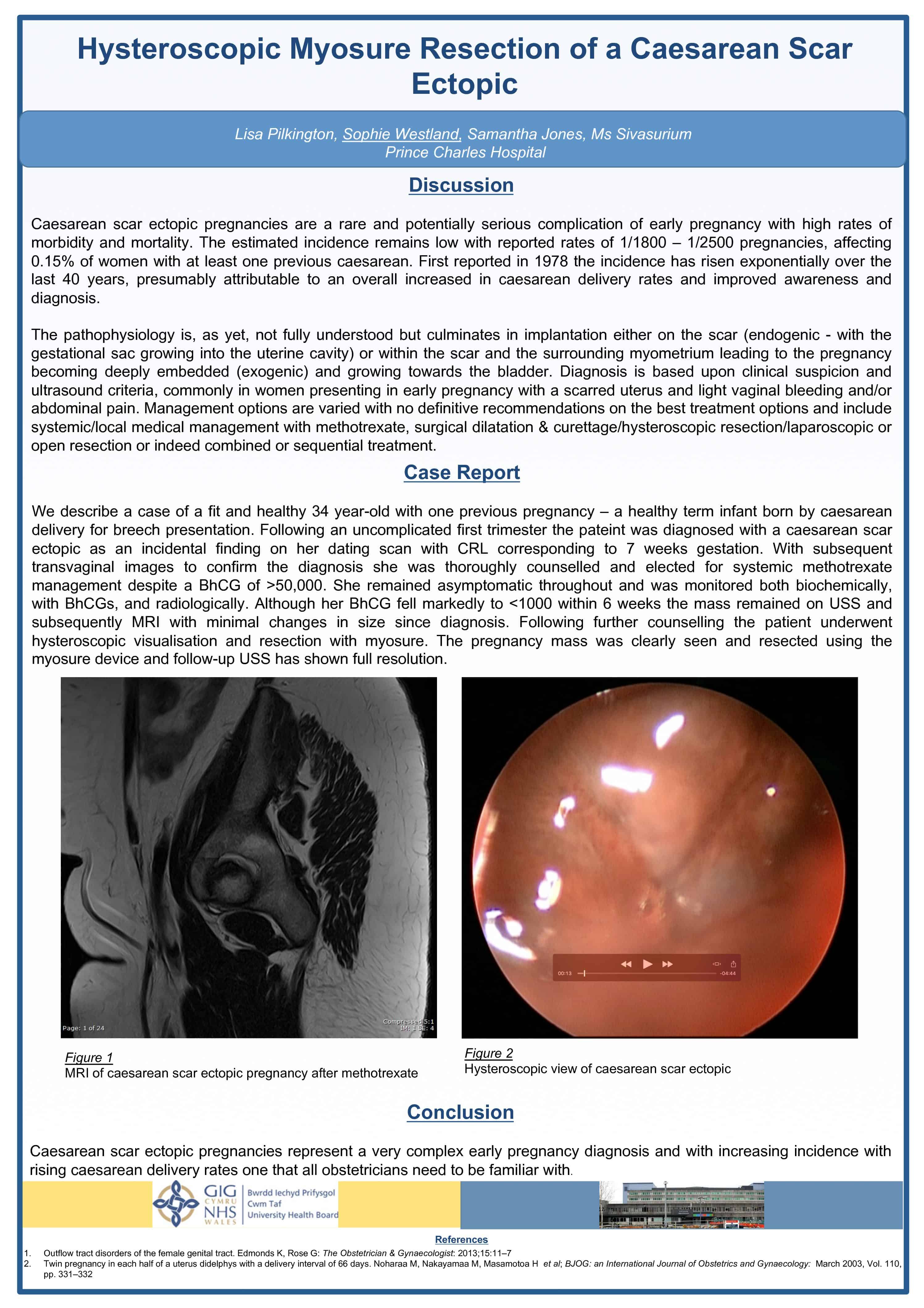 Hysteroscopic myosure resection of a caesarean scar ectopic