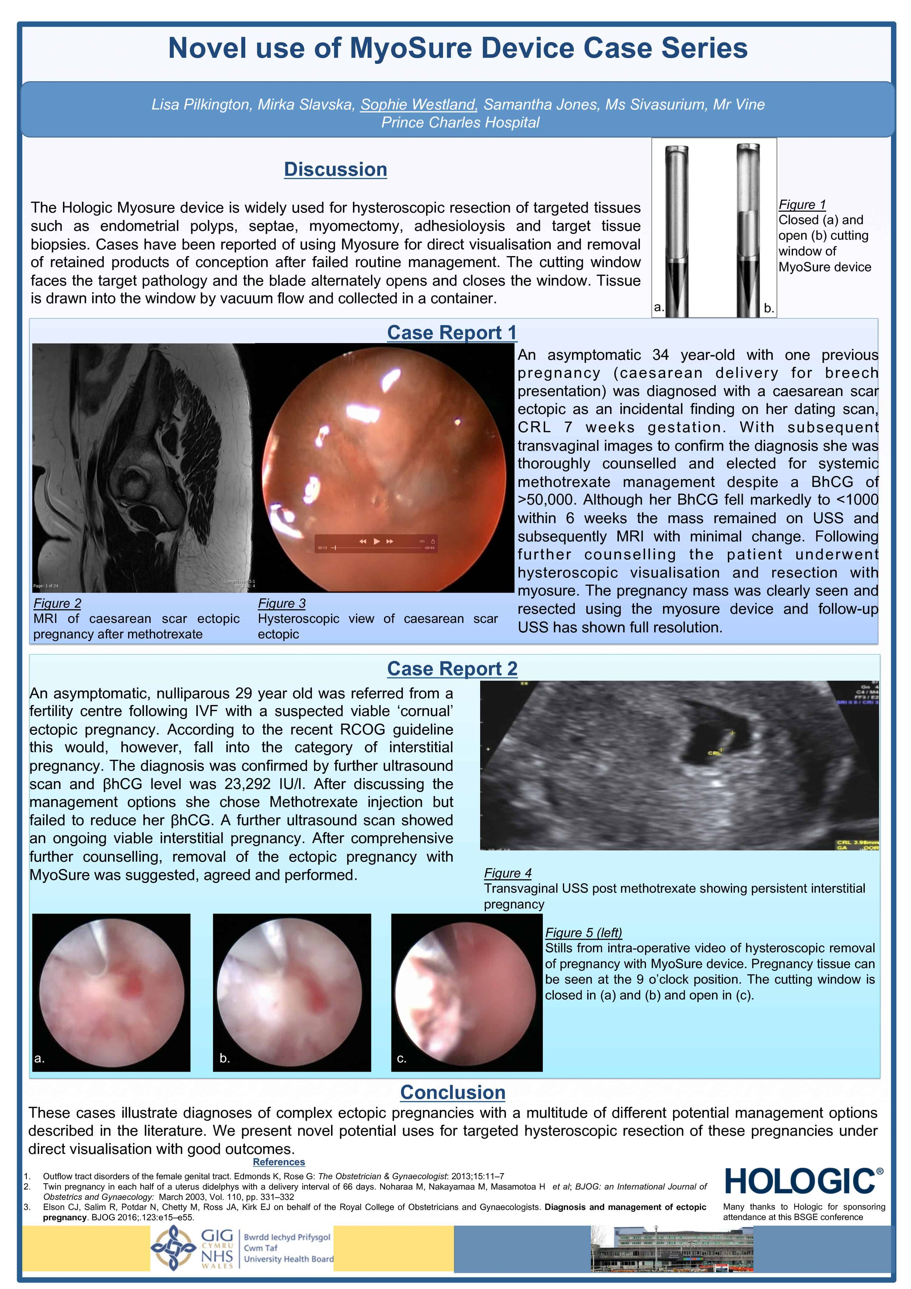 Novel use of myosure device case series