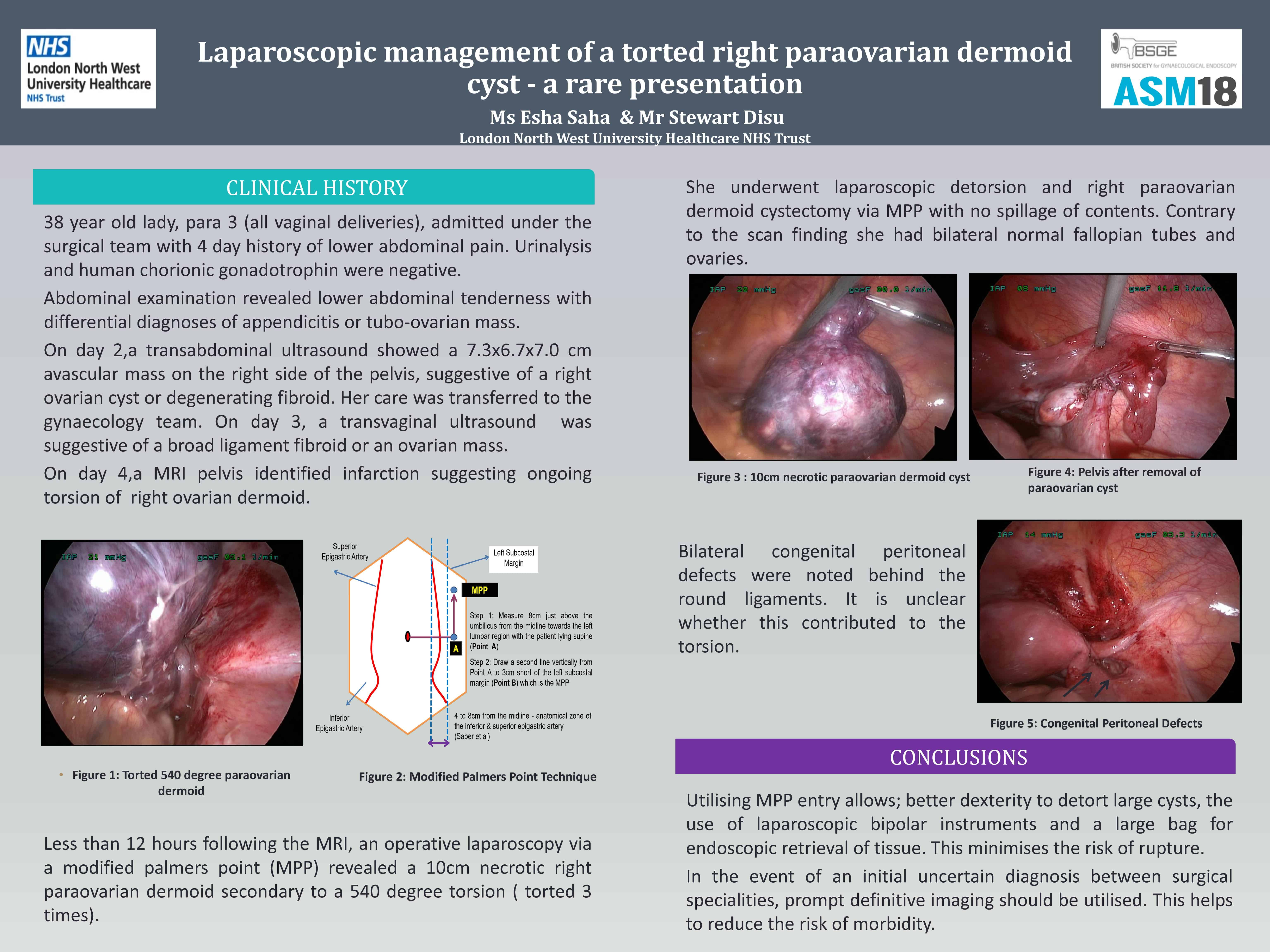Laparoscopic management of a torted right paraovarian dermoid cyst – a rare presentation