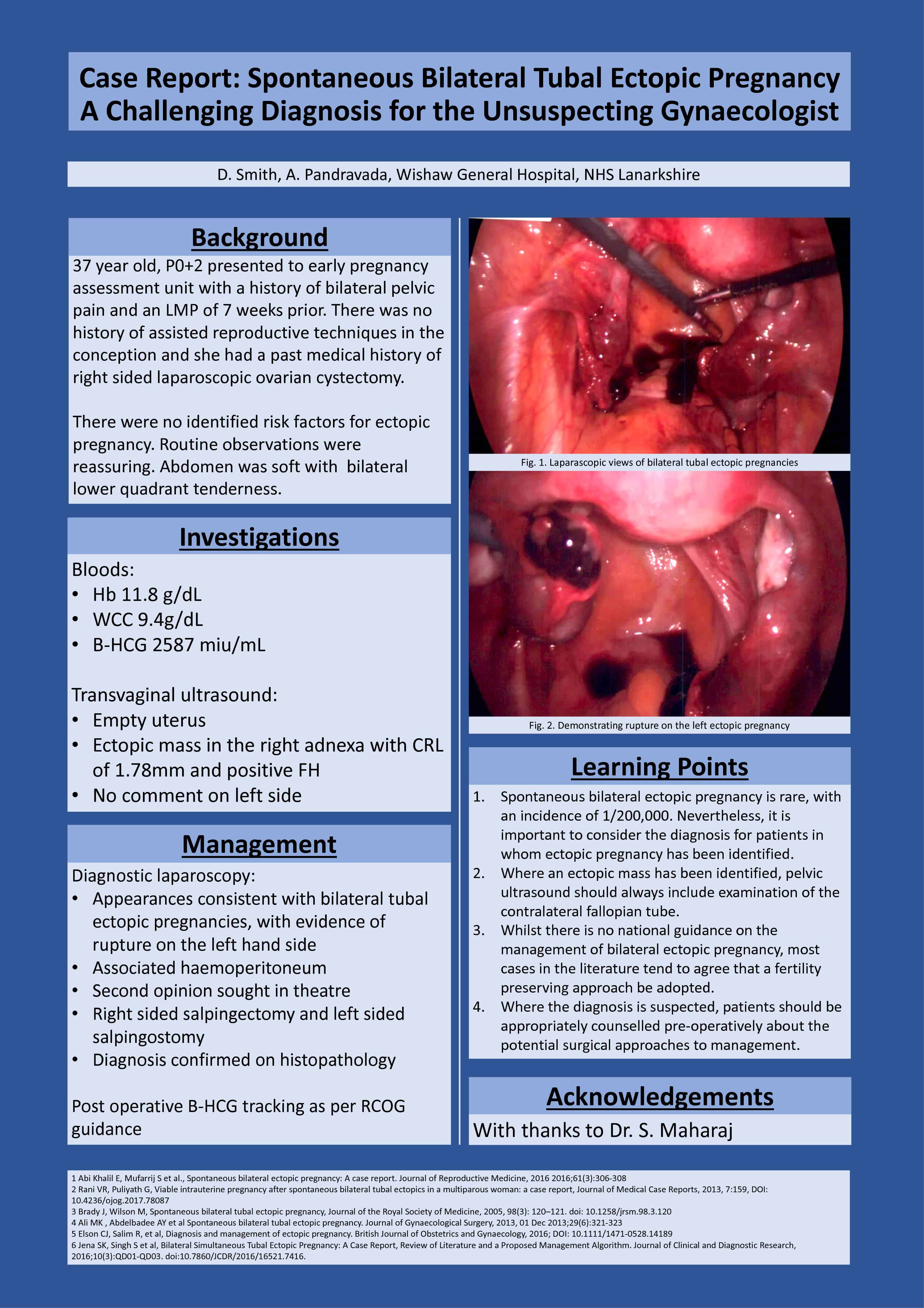 Case Report: Spontaneous Bilateral Tubal Ectopic Pregnancy