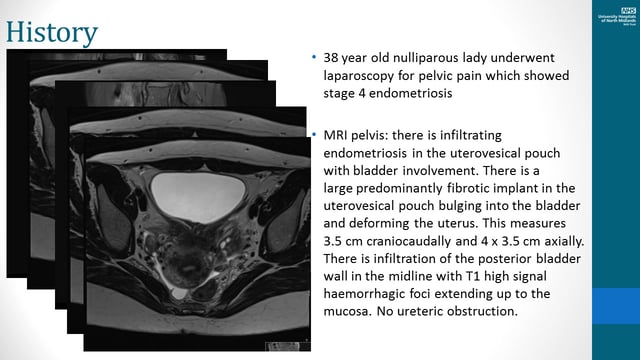 Combined approach for the Management of bladder endometriosis