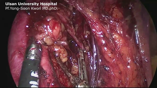 Complete dissection of paraaortic lymph node using 5-port laparoscopic approach