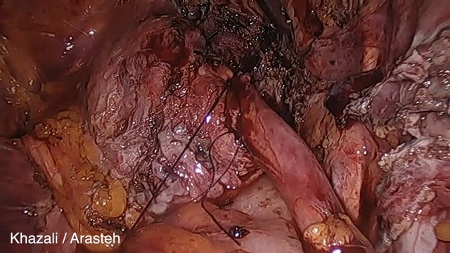 Distal ureteric endometriotic nodule. Laparoscopic partial cystectomy and ureteroneocystostomy.