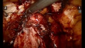 Laparoscopic and robotic vaginal suspension following radical surgery for bladder cancer