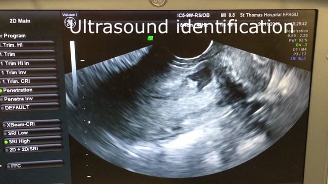 Laparoscopic Caesarean niche resection a step-wise approach