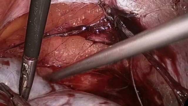 Laparoscopic Enucleation and Excision of a Rare Retroperitoneal Mullerian Cyst