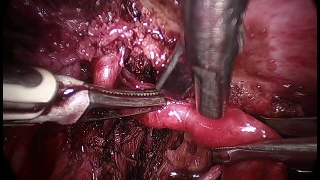 Laparoscopic Ureteric stricturoplasty using a modified Heineke-Mikulicz approach for Ureteric Stricture secondary to severe endometriosis