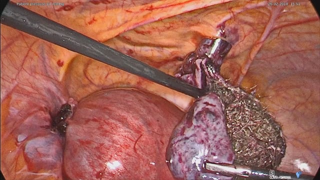Laparoscopy in Pregnancy- Management of Acute Ovarian Torsion