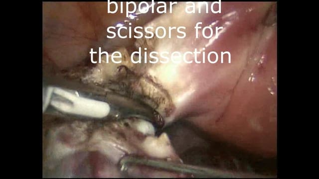 Laparoscopy in the management of Borderline Ovarian Tumours – Key Principles