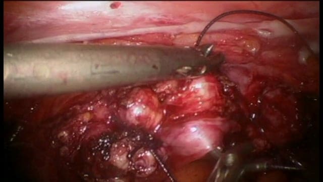 Pearls of laparoscopic hysterectomy