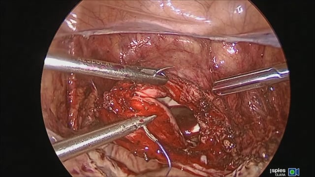 Reverse hysterectomy- a modified technique for laparoscopic hysterectomy