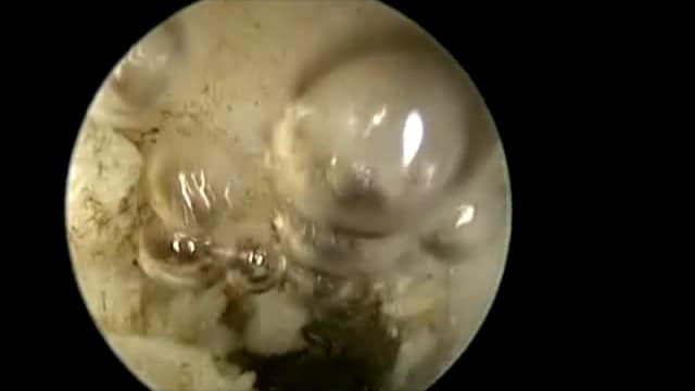 Safe division of cervical synechiae under direct vision a step-wise approach