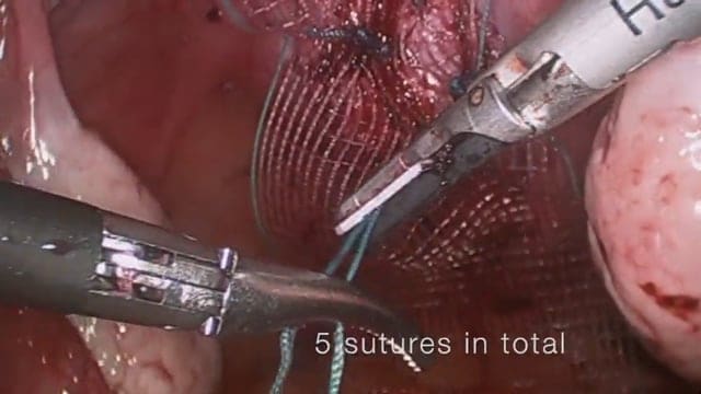 Simplified Laparoscopic Sacrohysteropexy