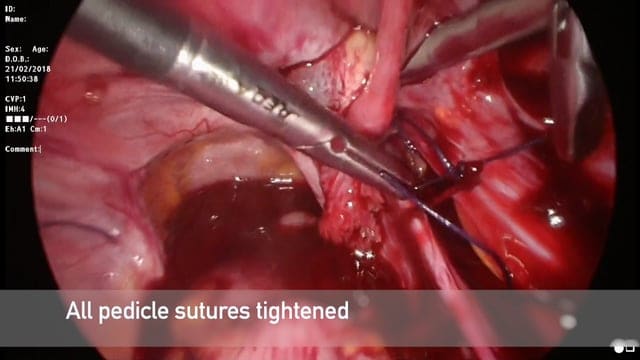Two Pedicle haemostatic approach for laparoscopic myomectomy