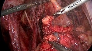 BOWEL ENDOMETRIOSIS COULD MISLEAD SURGEONS! LAPAROSCOPIC CASE OF BOWEL RESECTION