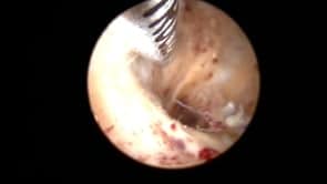 Demonstration of hysteroscopic submucosal fibroid removal using Truclear Ultramini Scope and Dense Tissue Shaver via vaginoscopy