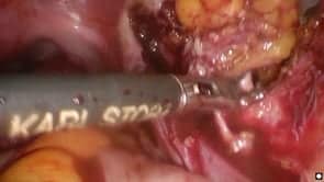 Excision of deep pelvic side wall disease with obturator nerve neurolysis