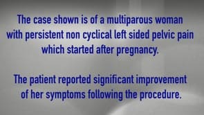 Is this real life ? Is this just fantasy? Pelvic Congestion Syndrome