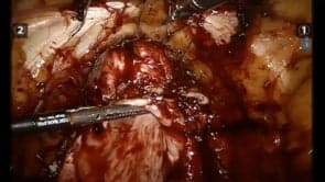 Laparoscopic Colposuspension following exenteration for Bladder Cancer