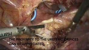 Laparoscopic excision of full thickness endometriotic bladder nodule