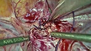 Laparoscopic suturing of Caesarean scar dehiscence
