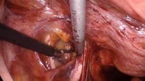 The Approach to Uterine Artery Ligation