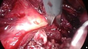 Total laparoscopic hysterectomy with a large broad ligament fibroid
