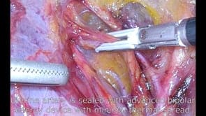 Uterine artery ligation at its origin. A technique to promote safety during total laparoscopic hysterectomy.